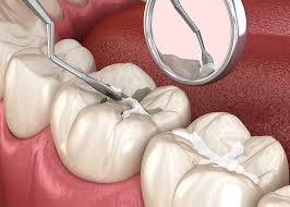 Pit and Fissure Sealants